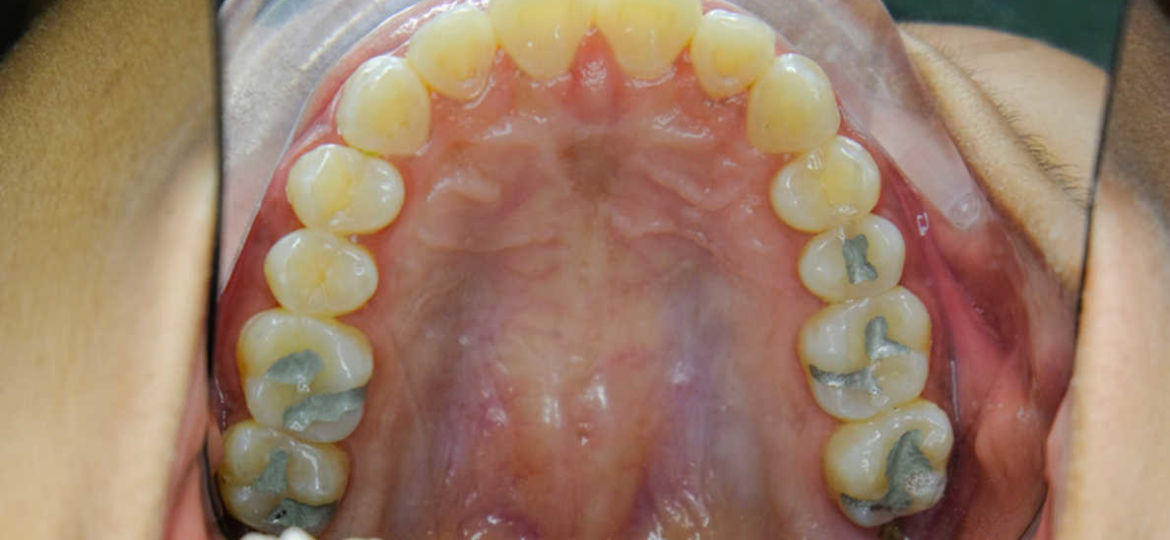 Recent-study-reveals-the-impact-of-dental-amalgam-on-the-environment_780-x-439-1188x668-