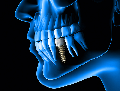 titanium-implant
