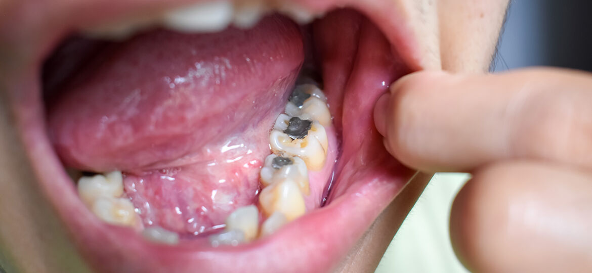 Silver,Amalgam,Fillings,At,Right,Lower,First,Molar,And,Left