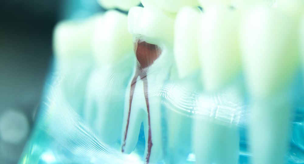 Dental,Tooth,Root,Canal,Dentists,Teeth,Model,Closeup.