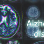 Alzheimer's disease or Parkinson concept. Blurred MRI scan of brain with glitch effect, toned