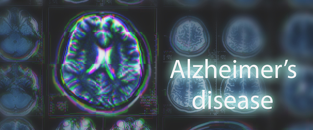 Alzheimer's,Disease,Or,Parkinson,Concept.,Blurred,Mri,Scan,Of,Brain